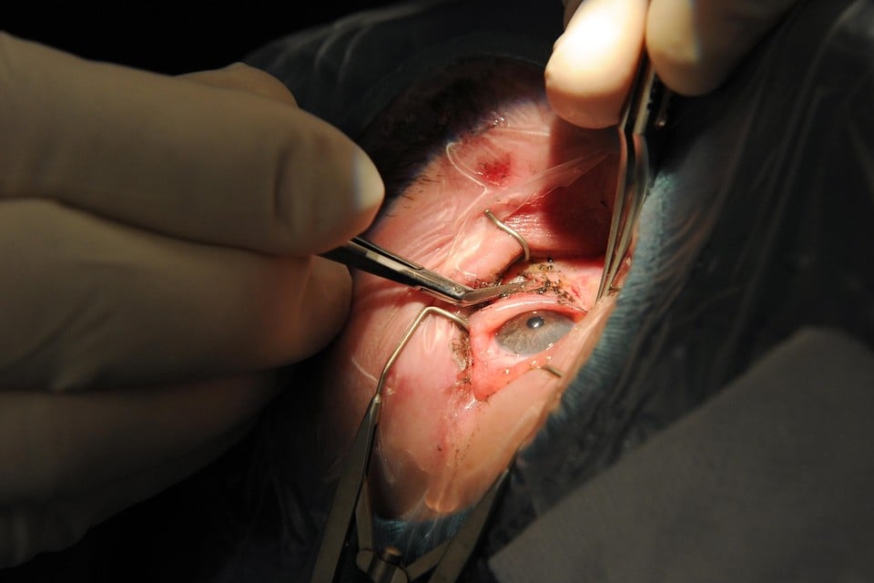 Een oogarts verwijdert vuurwerkresten uit een oog.